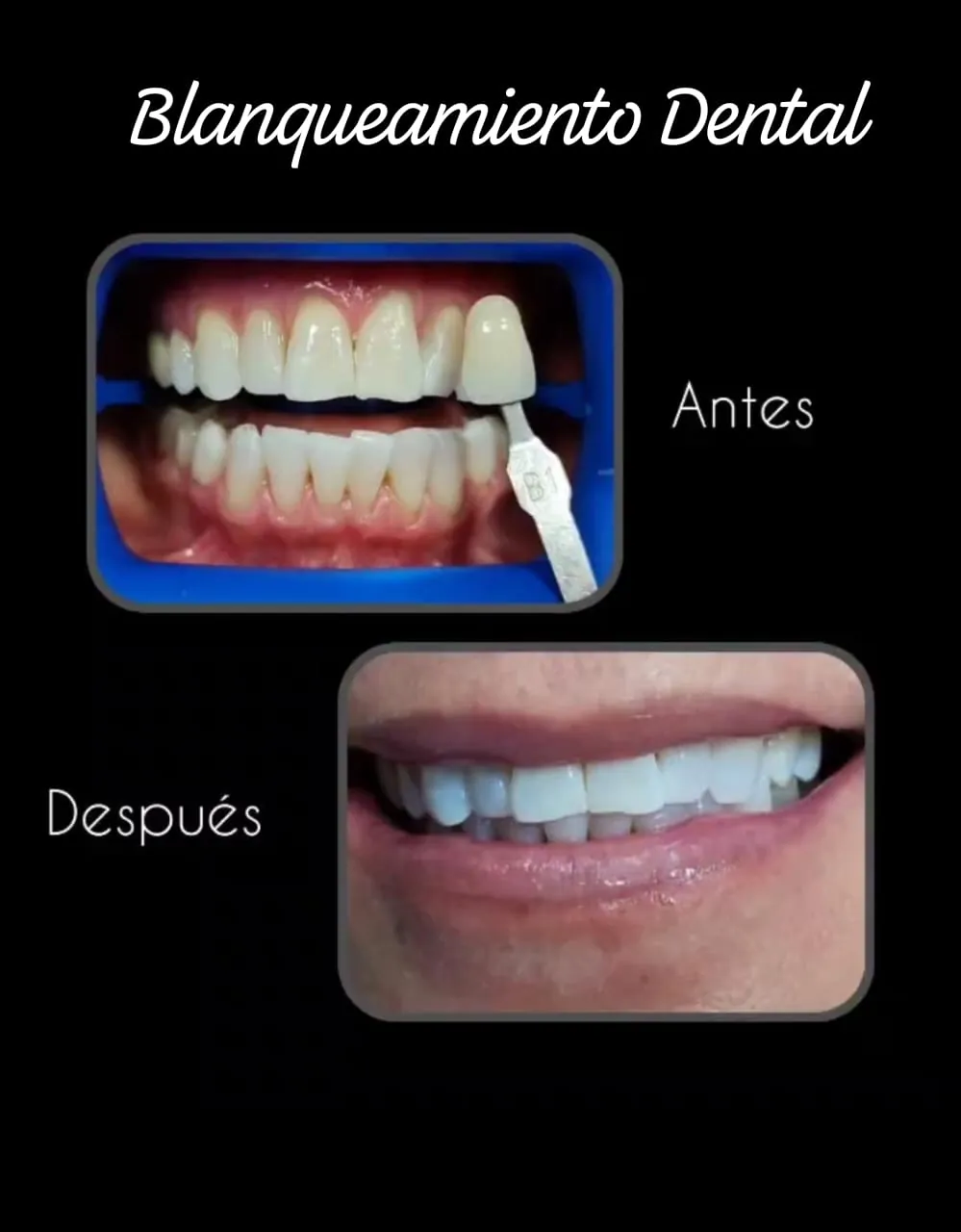 Blanqueamiento Dental